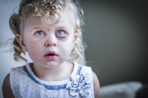 Sad, Bruised and Frightened Little Girl